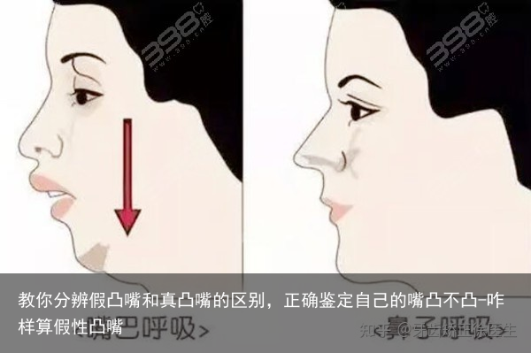 教你分辨假凸嘴和真凸嘴的区别，正确鉴定自己的嘴凸不凸-咋样算假性凸嘴