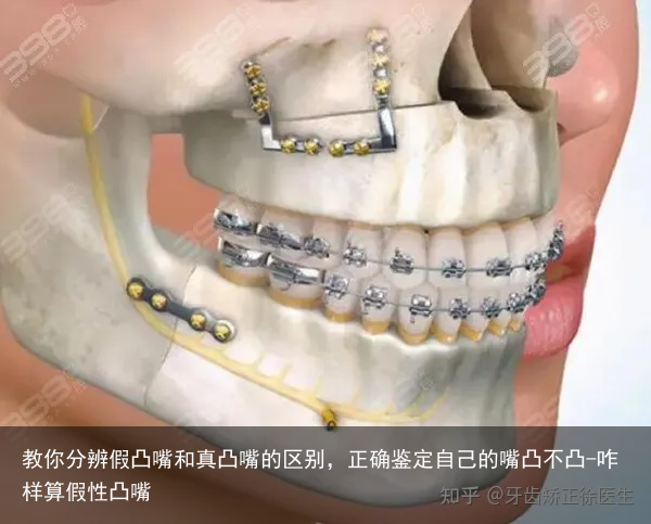 教你分辨假凸嘴和真凸嘴的区别，正确鉴定自己的嘴凸不凸-咋样算假性凸嘴