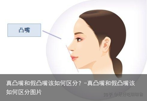 真凸嘴和假凸嘴该如何区分？-真凸嘴和假凸嘴该如何区分图片