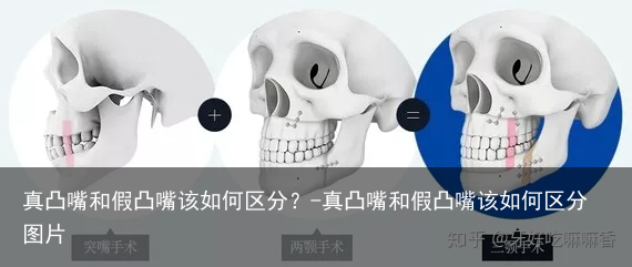 真凸嘴和假凸嘴该如何区分？-真凸嘴和假凸嘴该如何区分图片