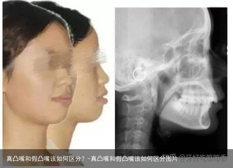 真凸嘴和假凸嘴该如何区分？-真凸嘴和假凸嘴该如何区分图片