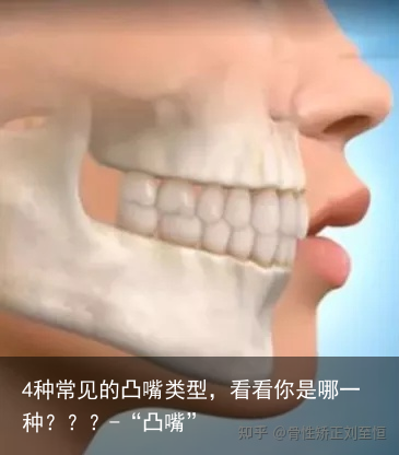 4种常见的凸嘴类型，看看你是哪一种？？？-“凸嘴”