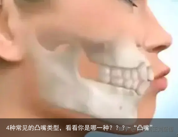 4种常见的凸嘴类型，看看你是哪一种？？？-“凸嘴”