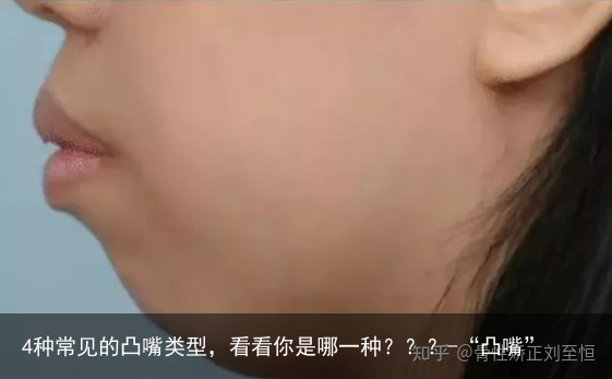 4种常见的凸嘴类型，看看你是哪一种？？？-“凸嘴”