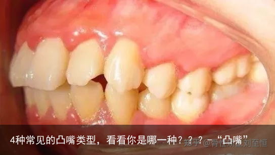 4种常见的凸嘴类型，看看你是哪一种？？？-“凸嘴”