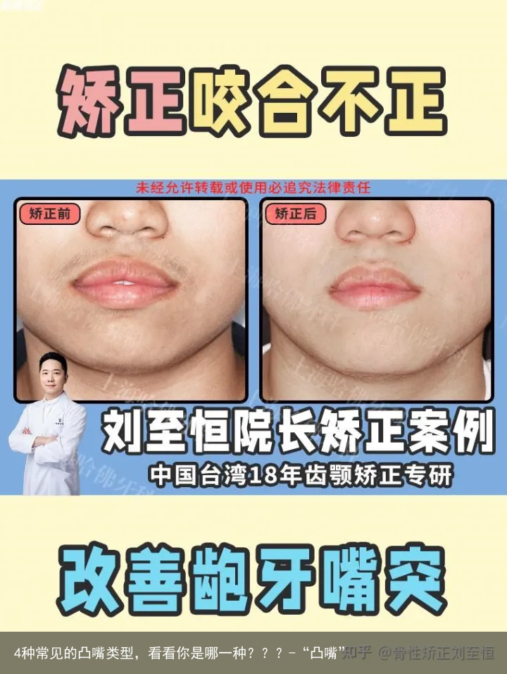 4种常见的凸嘴类型，看看你是哪一种？？？-“凸嘴”