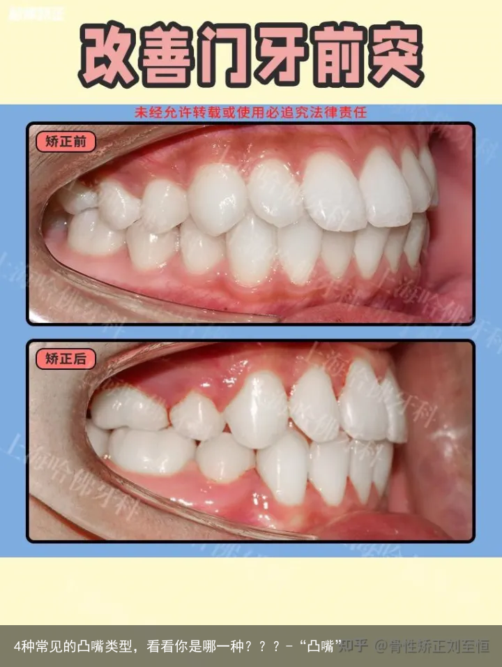 4种常见的凸嘴类型，看看你是哪一种？？？-“凸嘴”