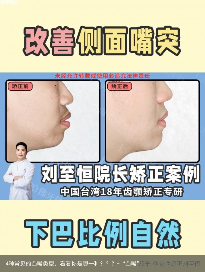 4种常见的凸嘴类型，看看你是哪一种？？？-“凸嘴”