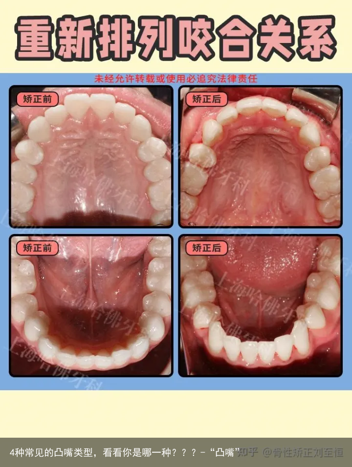 4种常见的凸嘴类型，看看你是哪一种？？？-“凸嘴”