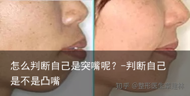 怎么判断自己是突嘴呢？-判断自己是不是凸嘴