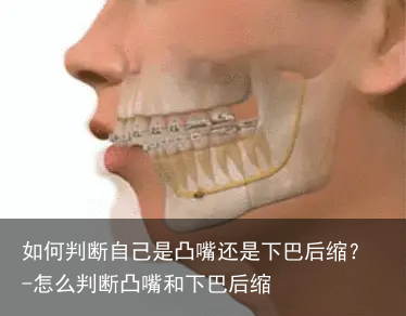 如何判断自己是凸嘴还是下巴后缩？-怎么判断凸嘴和下巴后缩