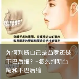 如何判断自己是凸嘴还是下巴后缩？-怎么判断凸嘴和下巴后缩