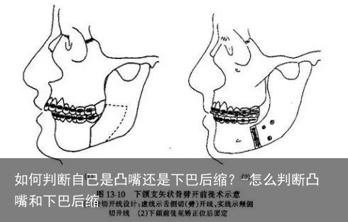 如何判断自己是凸嘴还是下巴后缩？-怎么判断凸嘴和下巴后缩
