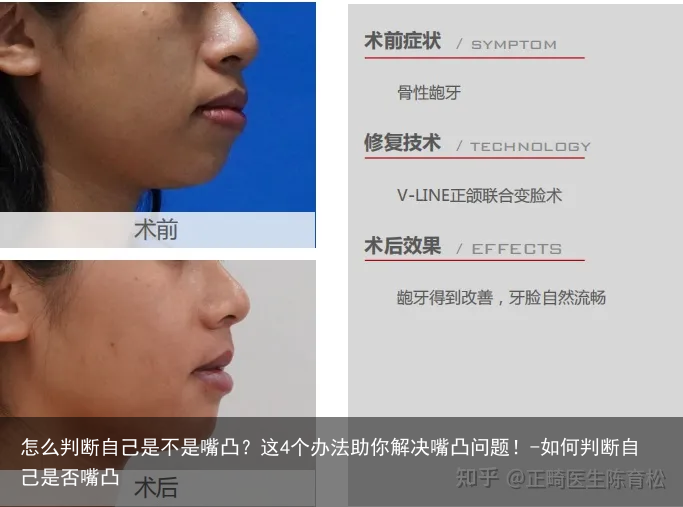 怎么判断自己是不是嘴凸？这4个办法助你解决嘴凸问题！-如何判断自己是否嘴凸