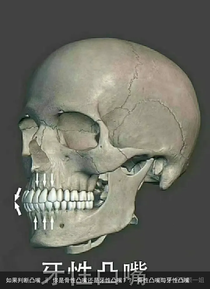 如果判断凸嘴 ‖ 你是骨性凸嘴还是牙性凸嘴？？-骨性凸嘴与牙性凸嘴