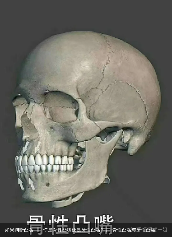 如果判断凸嘴 ‖ 你是骨性凸嘴还是牙性凸嘴？？-骨性凸嘴与牙性凸嘴