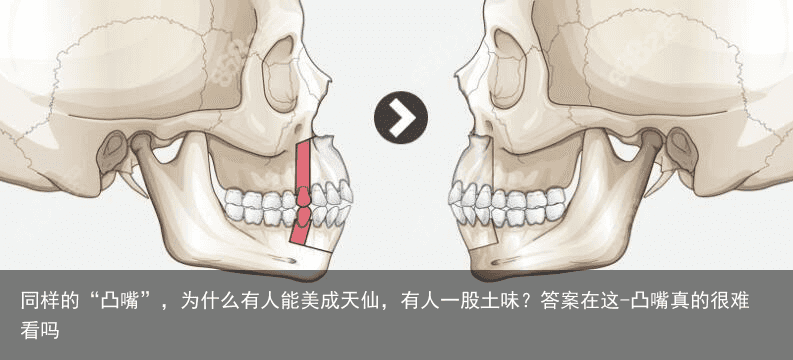 同样的“凸嘴”，为什么有人能美成天仙，有人一股土味？答案在这-凸嘴真的很难看吗