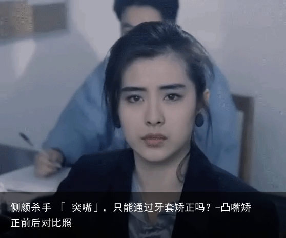 侧颜杀手 「 突嘴」，只能通过牙套矫正吗？-凸嘴矫正前后对比照