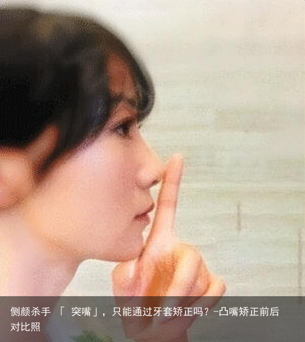 侧颜杀手 「 突嘴」，只能通过牙套矫正吗？-凸嘴矫正前后对比照