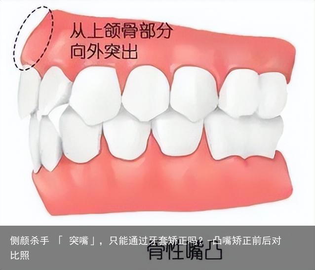 侧颜杀手 「 突嘴」，只能通过牙套矫正吗？-凸嘴矫正前后对比照