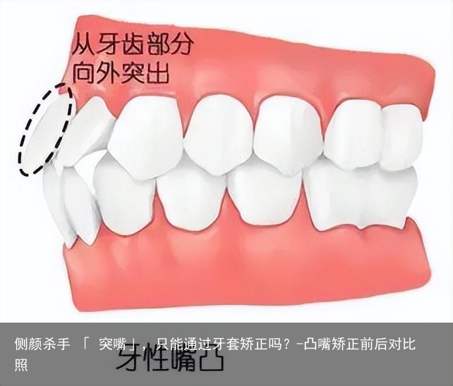 侧颜杀手 「 突嘴」，只能通过牙套矫正吗？-凸嘴矫正前后对比照