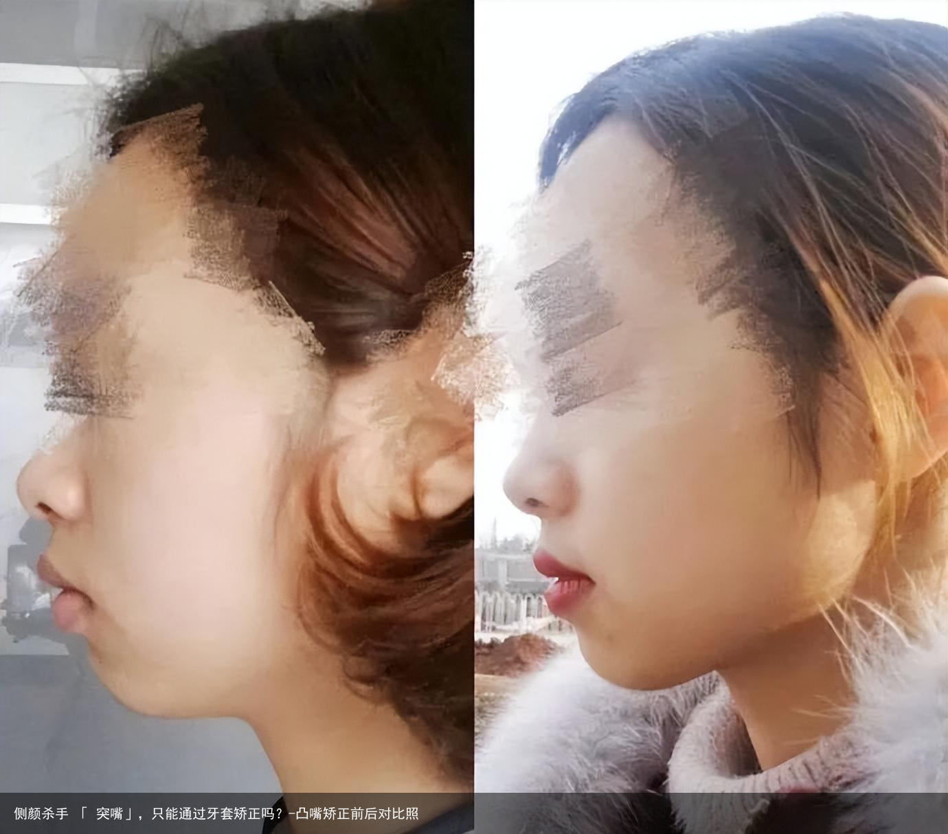 侧颜杀手 「 突嘴」，只能通过牙套矫正吗？-凸嘴矫正前后对比照