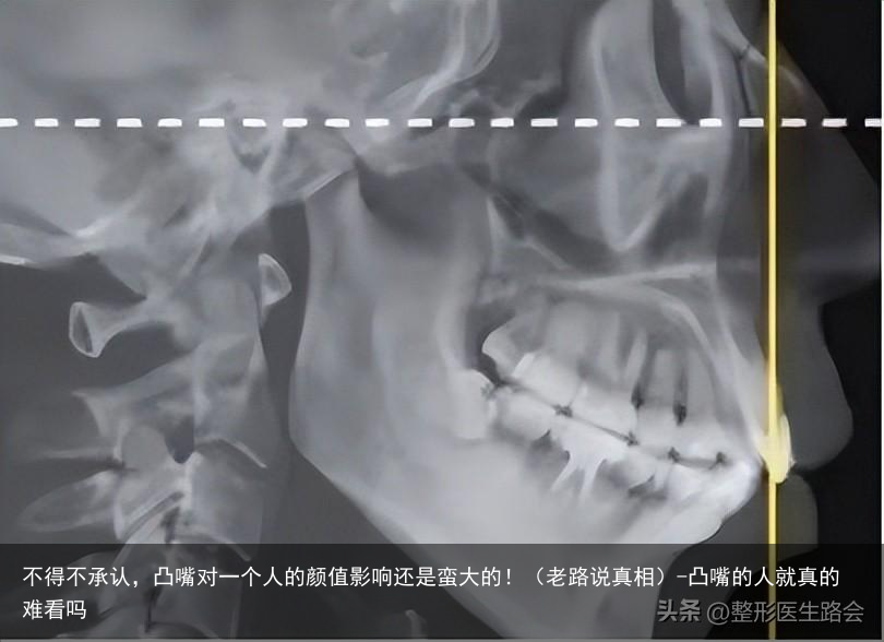 不得不承认，凸嘴对一个人的颜值影响还是蛮大的！（老路说真相）-凸嘴的人就真的难看吗