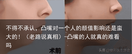 不得不承认，凸嘴对一个人的颜值影响还是蛮大的！（老路说真相）-凸嘴的人就真的难看吗