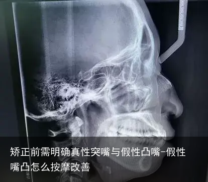 矫正前需明确真性突嘴与假性凸嘴-假性嘴凸怎么按摩改善