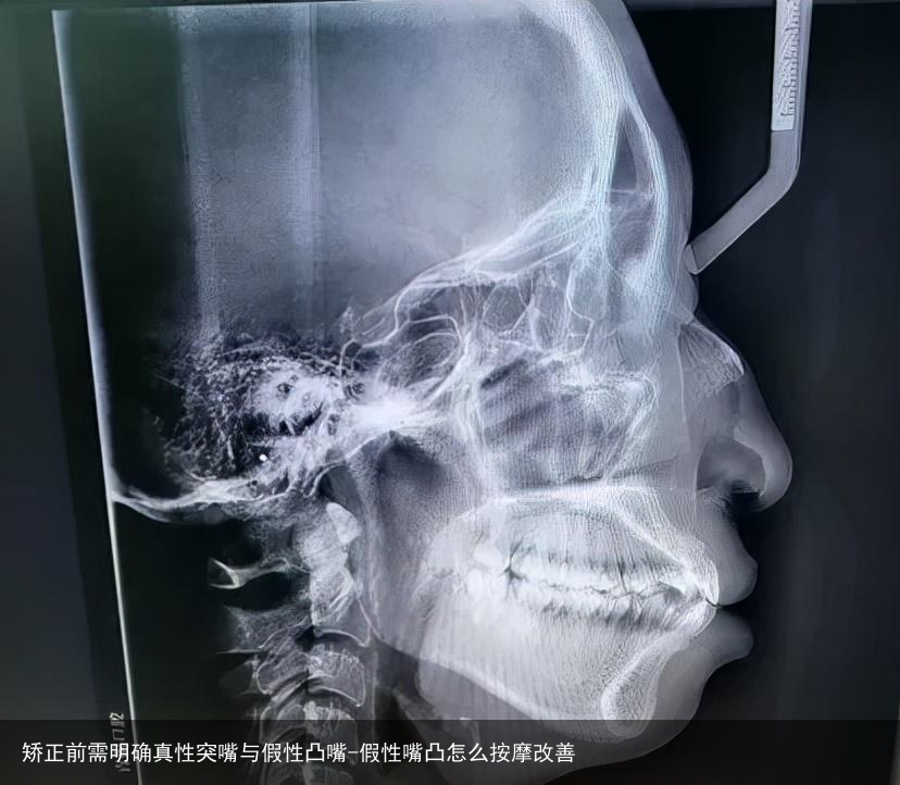矫正前需明确真性突嘴与假性凸嘴-假性嘴凸怎么按摩改善