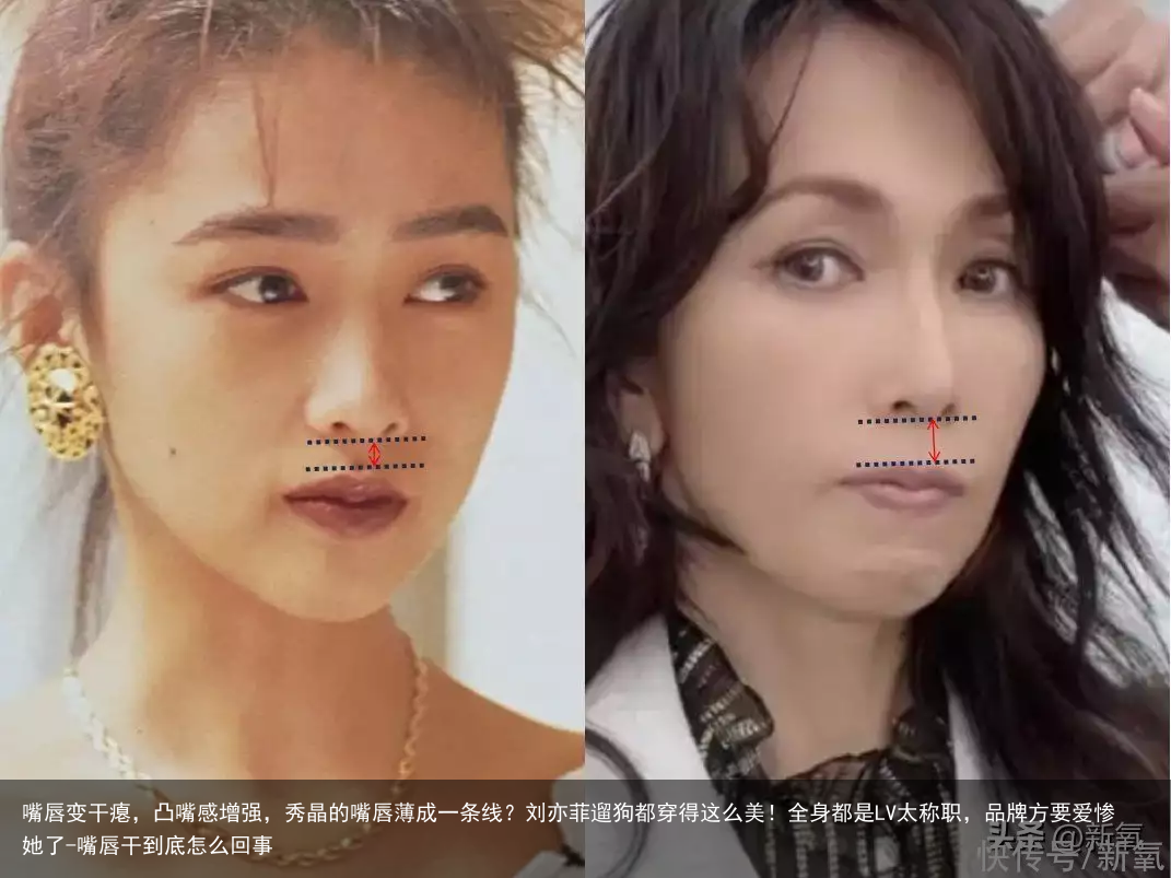 嘴唇变干瘪，凸嘴感增强，秀晶的嘴唇薄成一条线？刘亦菲遛狗都穿得这么美！全身都是LV太称职，品牌方要爱惨她了-嘴唇干到底怎么回事