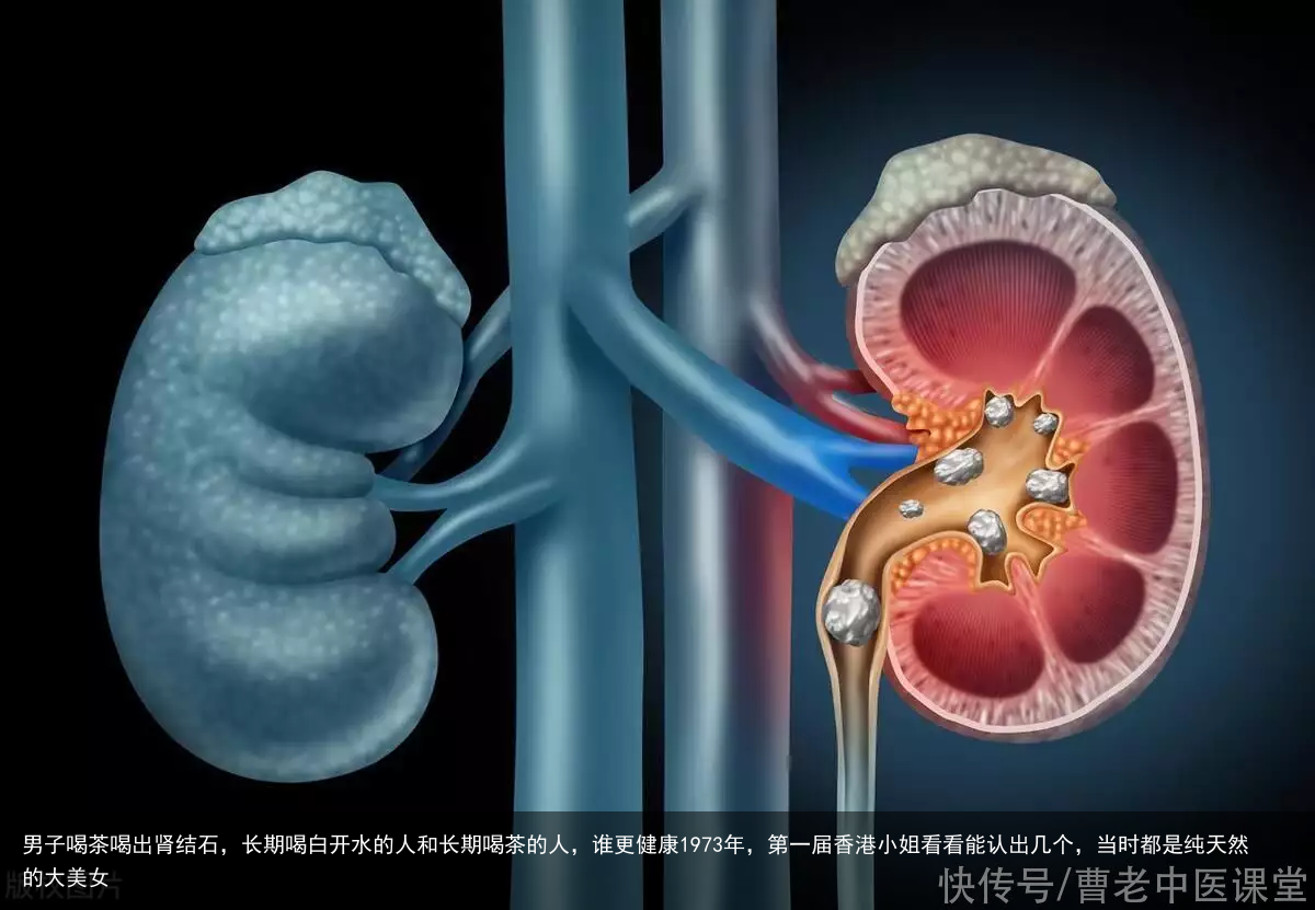 男子喝茶喝出肾结石，长期喝白开水的人和长期喝茶的人，谁更健康
