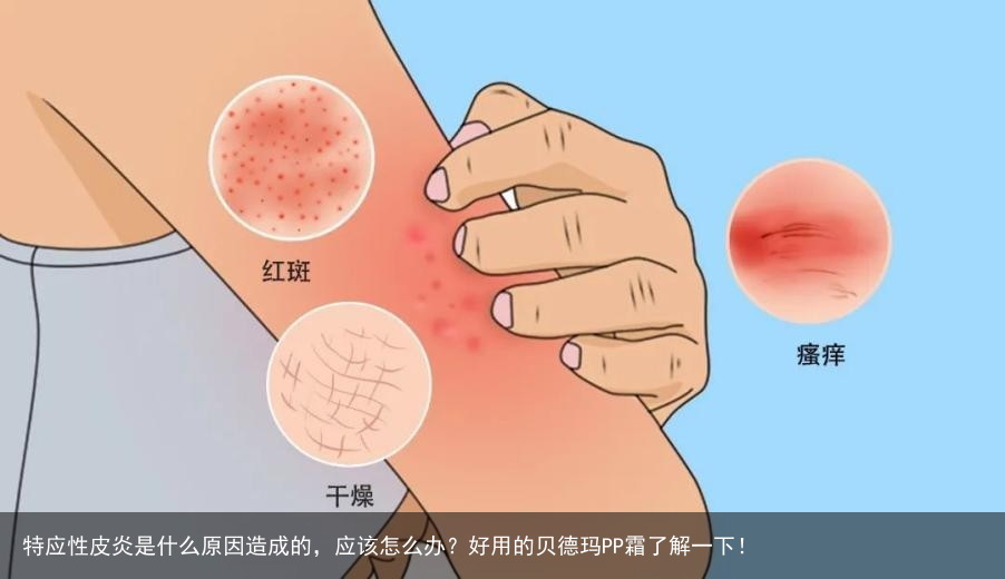 特应性皮炎是什么原因造成的，应该怎么办？好用的贝德玛PP霜了解一下！