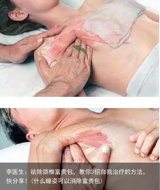 李医生：祛除颈椎富贵包，教你3招自我治疗的方法，快分享！(什么睡姿可以消除富贵包)
