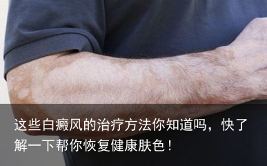 这些白癜风的治疗方法你知道吗，快了解一下帮你恢复健康肤色！