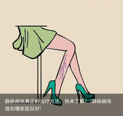 静脉曲张真正的治疗方法，快来了解！(静脉曲张微创哪家医院好)