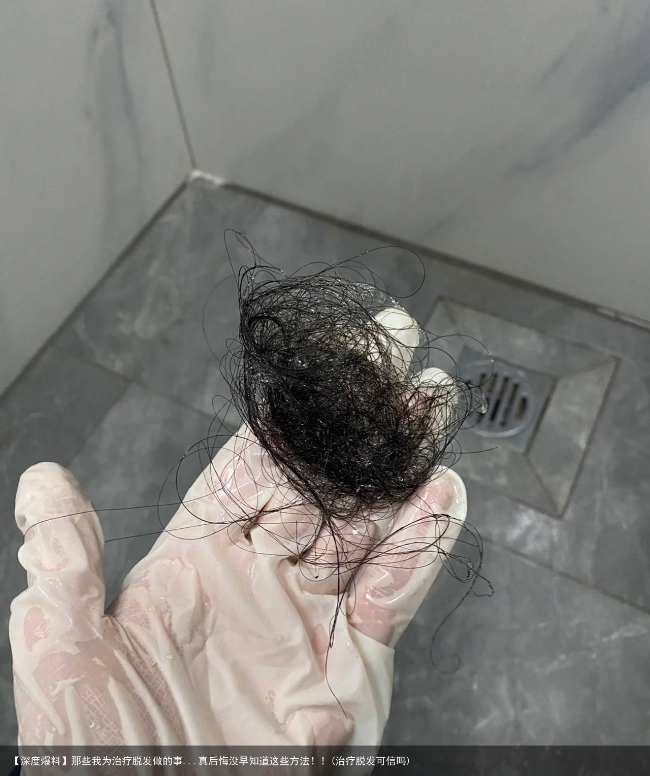 【深度爆料】那些我为治疗脱发做的事...真后悔没早知道这些方法！！(治疗脱发可信吗)
