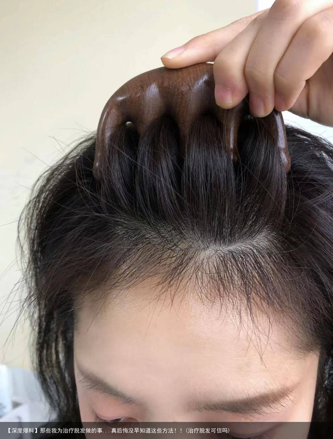 【深度爆料】那些我为治疗脱发做的事...真后悔没早知道这些方法！！(治疗脱发可信吗)
