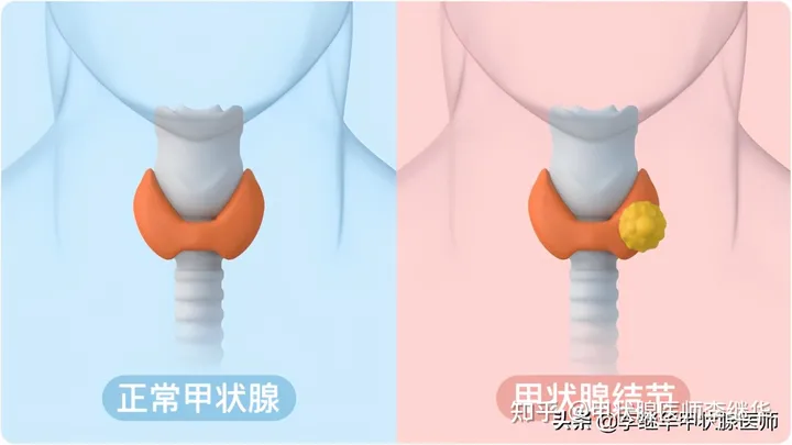 有甲状腺结节，春季养肝很关键，做好这9点促进结节消散(甲状腺结节要怎么饮食)