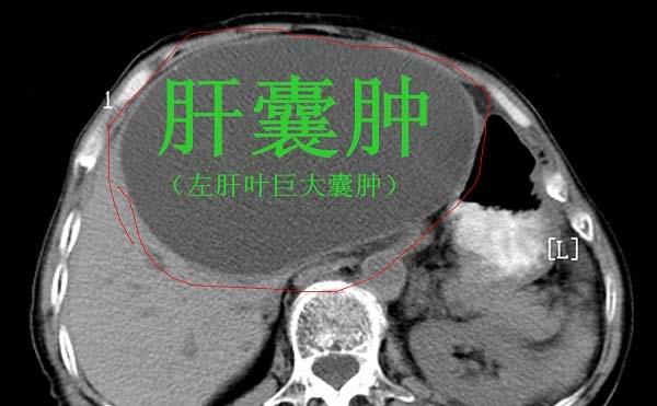 肝脏结节是恶性的吗？是不是要手术切除？看完此文你自己都会治了(肝脏有结节不管是良性还是恶性最好做掉吗)