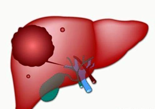 肝脏结节是恶性的吗？是不是要手术切除？看完此文你自己都会治了(肝脏有结节不管是良性还是恶性最好做掉吗)