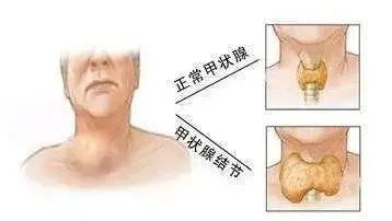 每个人身上都可能有“结节”！结节到底是什么？怎么消除？