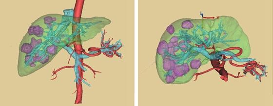 肝脏结节是恶性的吗？是不是要手术切除？看完此文你自己都会治了