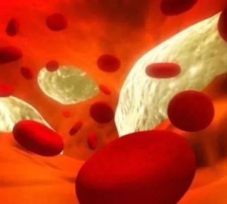 甘油三酯越高，血管堵塞越严重，3个技巧能快速降血脂通血管