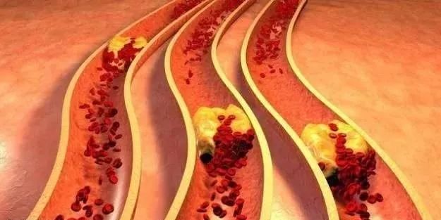 甘油三酯越高，血管堵塞越严重，3个技巧能快速降血脂通血管