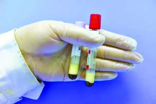 甘油三脂3-5算是严重超标吗？吃什么可以降下来？医生说清楚