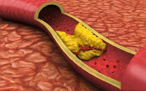 甘油三脂3-5算是严重超标吗？吃什么可以降下来？医生说清楚