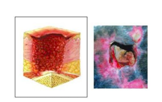 29岁抗癌母亲，是丈夫直播求打赏的工具，也是被蛆吃出洞的女人（26岁抗癌妈妈）