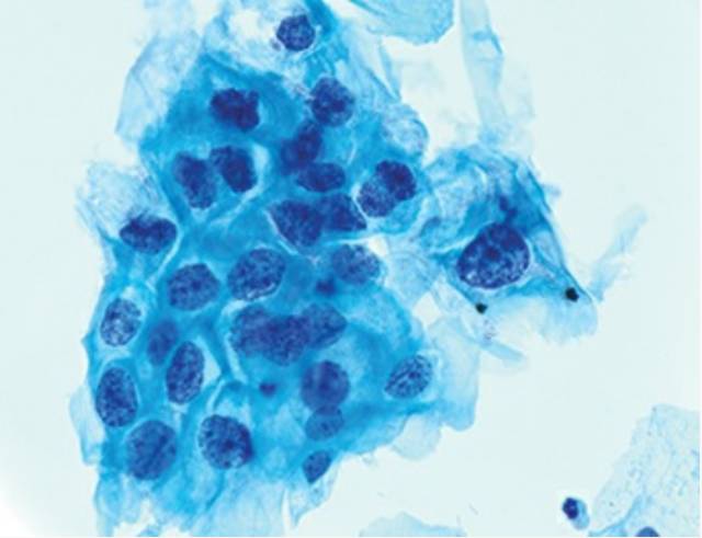 细胞学为低度鳞状上皮内病变的管理-体检结果低度鳞状上皮内病变