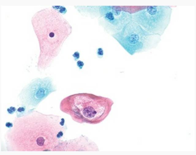 【学术前沿】细胞学为低度鳞状上皮内病变的管理-低度鳞状上皮内病变的治疗